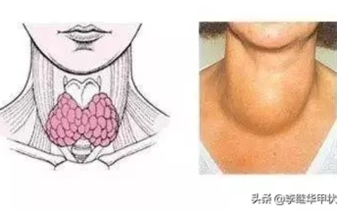 甲状腺的位置图片(甲状腺的早期症状和前兆)