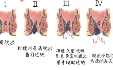 痔疮最佳的自愈方法用什么药膏(痔疮最佳的自愈方法吃什么食物)