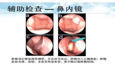 鼻炎的图片大全图片(鼻炎的图片症状图片大全)