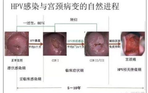 cin3到宫颈癌要多久(cin3累及腺体)