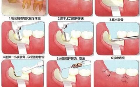 拔除智齿多少钱一颗(拔除智齿多少钱?)